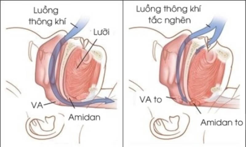 ngủ ngáy là bệnh gì